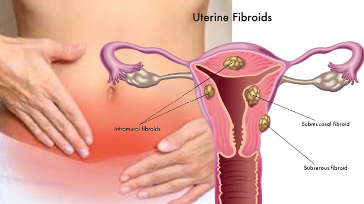 Hysterectomy