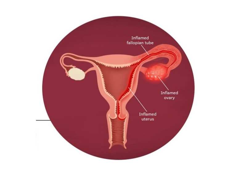 Pelvic Inflammatory Disease