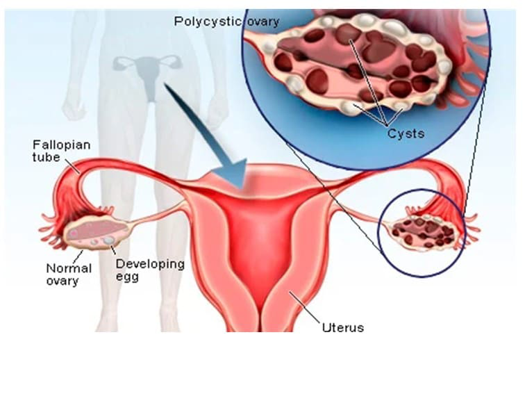 PCOS - Causes, Symptoms & Diagnosis